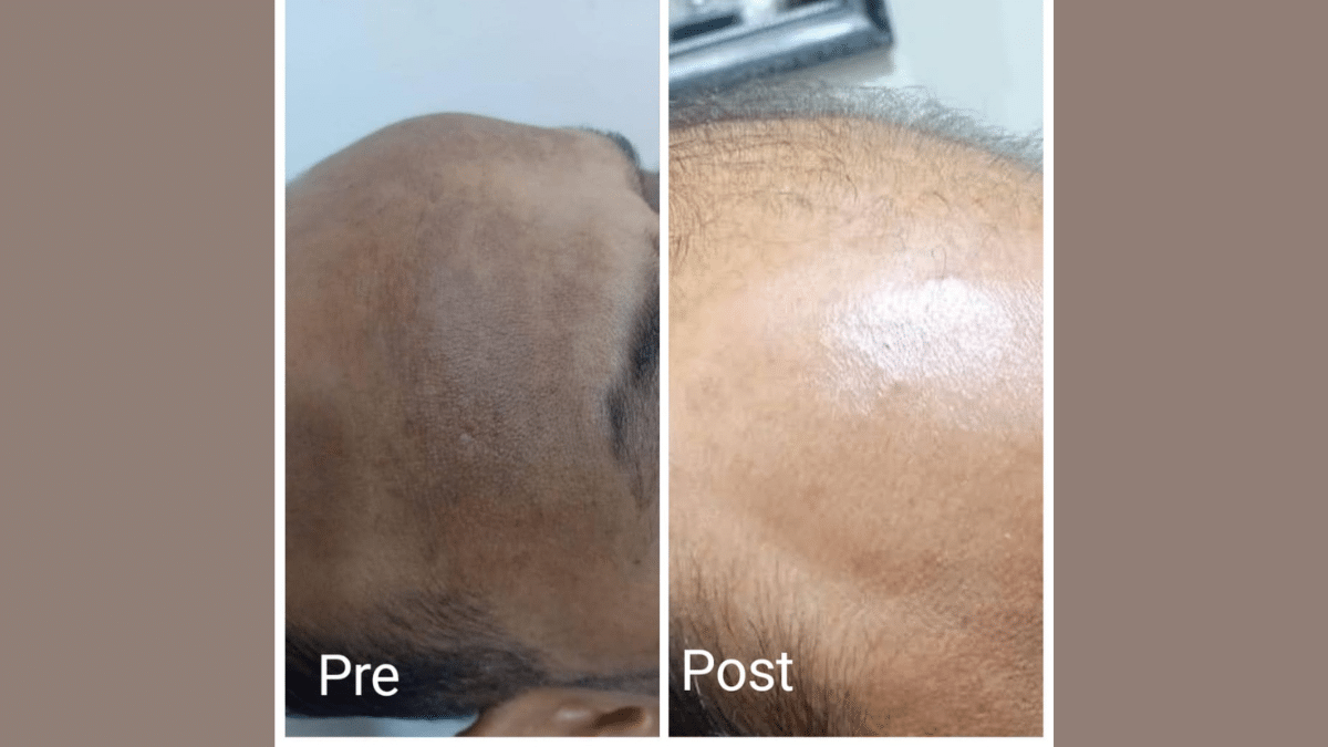 Melasma treatment in Hurghada